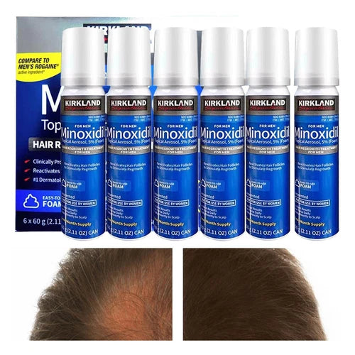 Producto de ejemploKirkland Signature Minoxidil 5% Foam – Tratamiento para el Crecimiento del Cabello para Hombres – 6 Meses